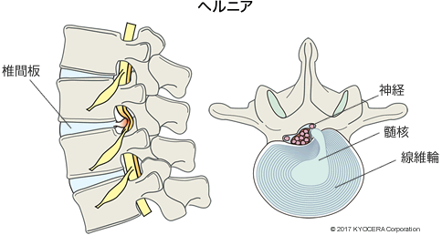 ヘルニア