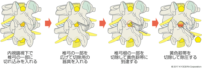 黄色靭帯を切除する除圧術