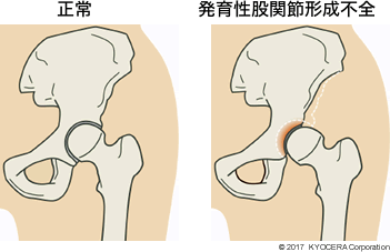 正常 発育性股関節形成不全