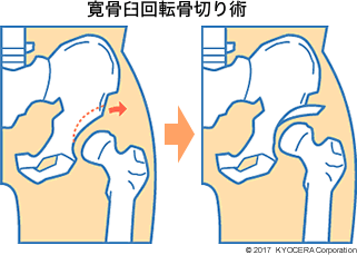 寛骨臼回転骨切り術