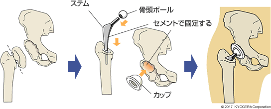 セメント固定人工股関節の例