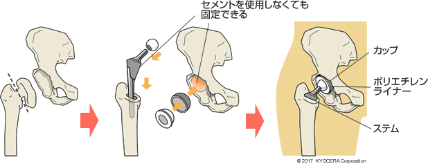 セメントレス固定人工股関節の例