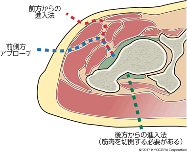 アプローチ法 拡大図