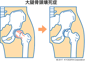 大腿骨頭壊死症