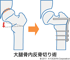 大腿骨内反骨切り術