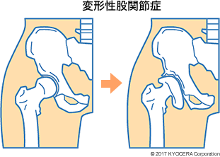 変形性股関節症