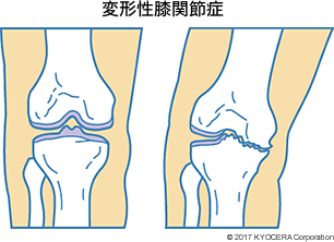 変形性膝関節症