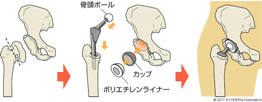 人工股関節置換術