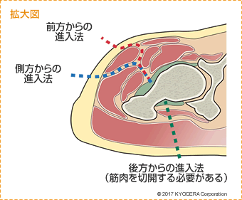 進入法 拡大図