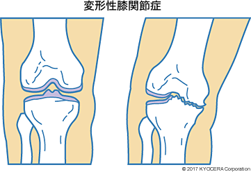 変形性膝関節症