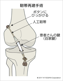 靭帯再建手術