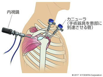 内視鏡を用いて断裂した部分を修復する手術