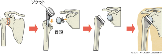 リバース型の人工肩関節置換術