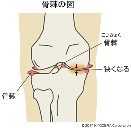 骨棘の図