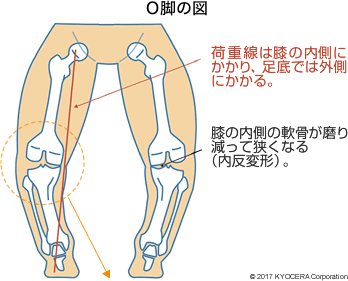 O脚の図