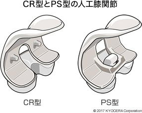 CR型とPS型の人工膝関節