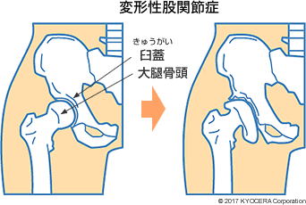 変形性股関節症