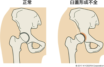 正常 臼蓋形成不全