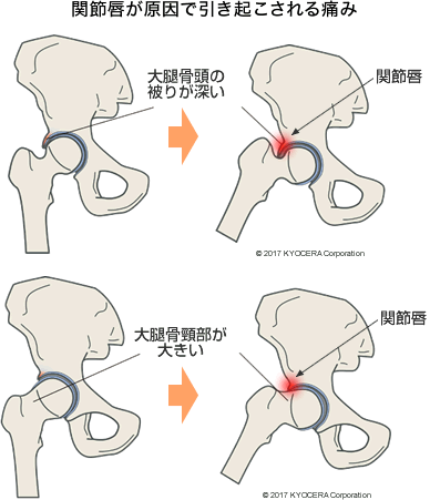 関節唇が原因で引き起こされる痛み