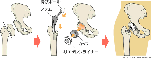 人工股関節全置換術