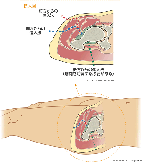 人工股関節全置換術