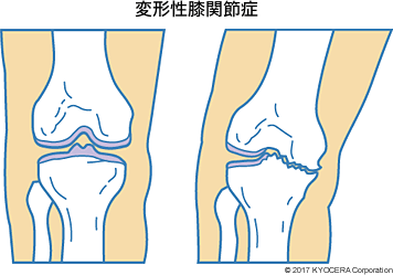 症 膝 関節 変形 性 実は膝に病気を持っています それは変形性膝関節症