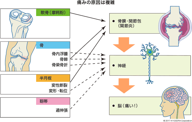 痛みの原因は複雑