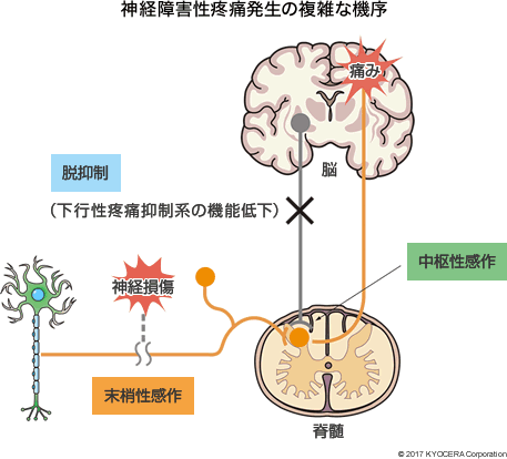 神経障害性疼痛発生の複雑な機序