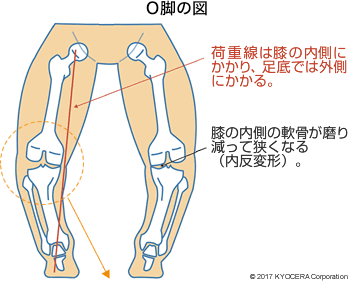 O脚の図