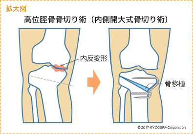 高位脛骨骨切り術（内側開大式骨切り術）