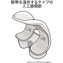 靭帯を温存するタイプの人工膝関節