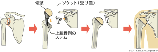 通常型の人工肩関節置換術