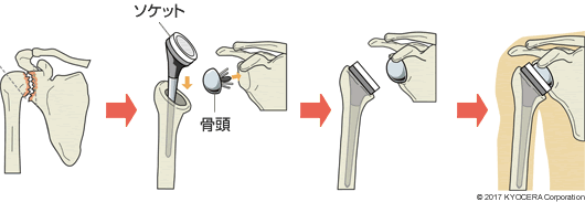 リバース型の人工肩関節置換術