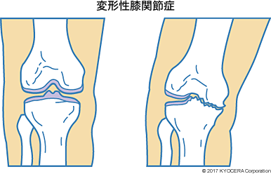 変形性膝関節症