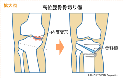 拡大図 高位脛骨骨切り術