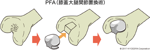 PFA（膝蓋大腿関節置換術）