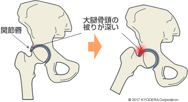 FAI 大腿骨頭の被りが深い