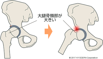 インピンジメント症候群 Fai 高橋 要 治療法 手術法 そして人工股関節にも色々な選択肢があります より最適な方法を共に考えましょう