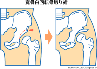 寛骨臼回転骨切り術