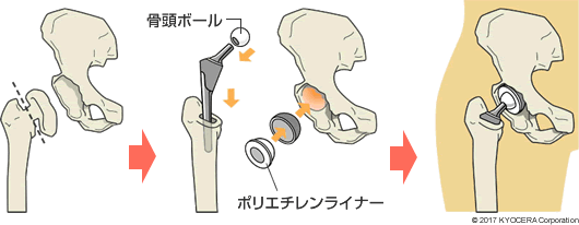 人工股関節置換術の例