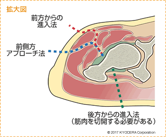 アプローチ 後方