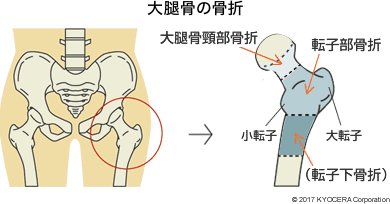 大腿骨の骨折