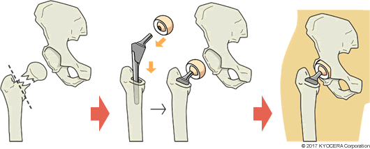 人工骨頭手術の例