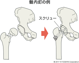 髄内釘の例