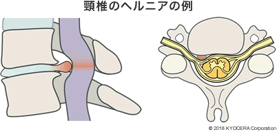 椎間板ヘルニア 高橋 敏行 頸椎の手術は 最新の神経モニタリングを使用することにより安全性が向上しています 手術は大きな神経障害を起こす前に行うのが望ましいでしょう