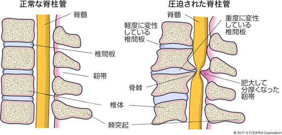 正常な脊柱管 圧迫された脊柱管