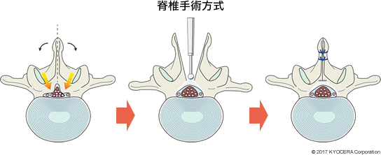 脊椎手術方式