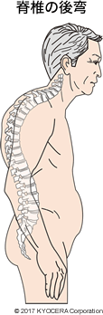 脊椎の後弯