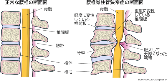 正常な腰椎の断面図 腰椎脊柱管狭窄症の断面図