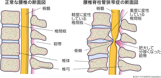 第 三 腰椎 圧迫 骨折